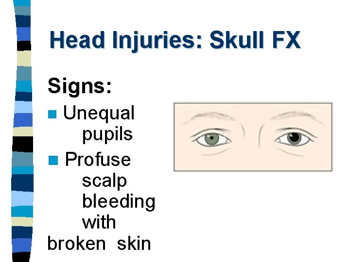 Head Injuries: Skull FX Signs: Unequal pupils n Profuse scalp bleeding with broken skin