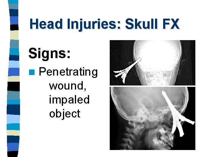 Head Injuries: Skull FX Signs: n Penetrating wound, impaled object 