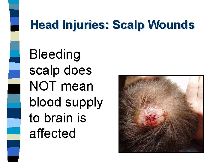Head Injuries: Scalp Wounds Bleeding scalp does NOT mean blood supply to brain is