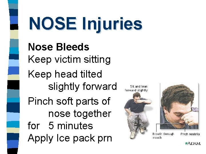 NOSE Injuries Nose Bleeds Keep victim sitting Keep head tilted slightly forward Pinch soft