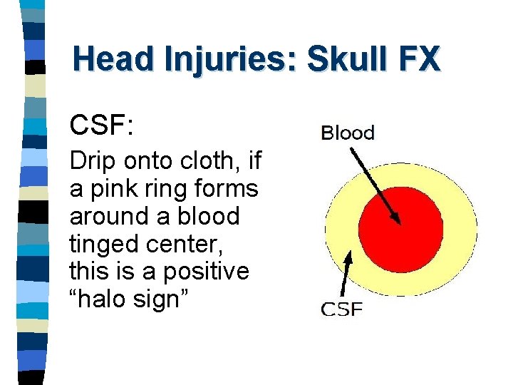 Head Injuries: Skull FX CSF: Drip onto cloth, if a pink ring forms around
