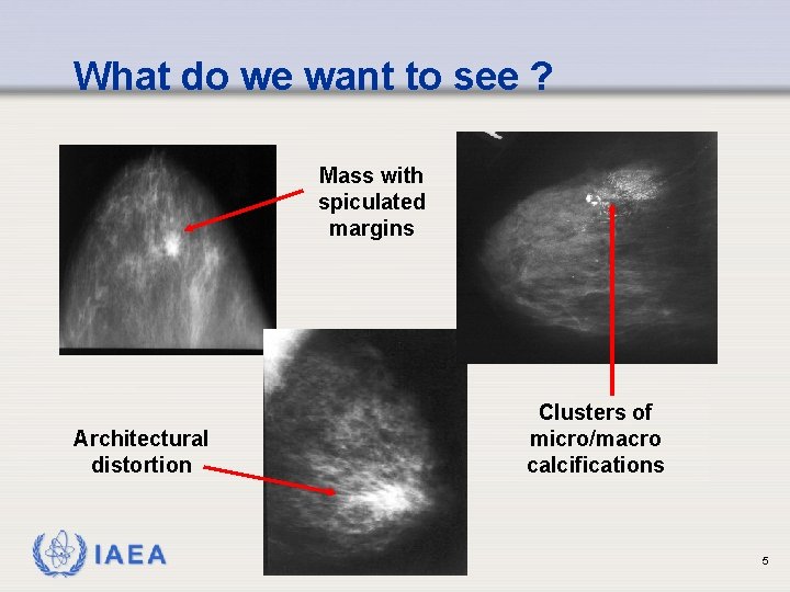 What do we want to see ? Mass with spiculated margins Architectural distortion IAEA