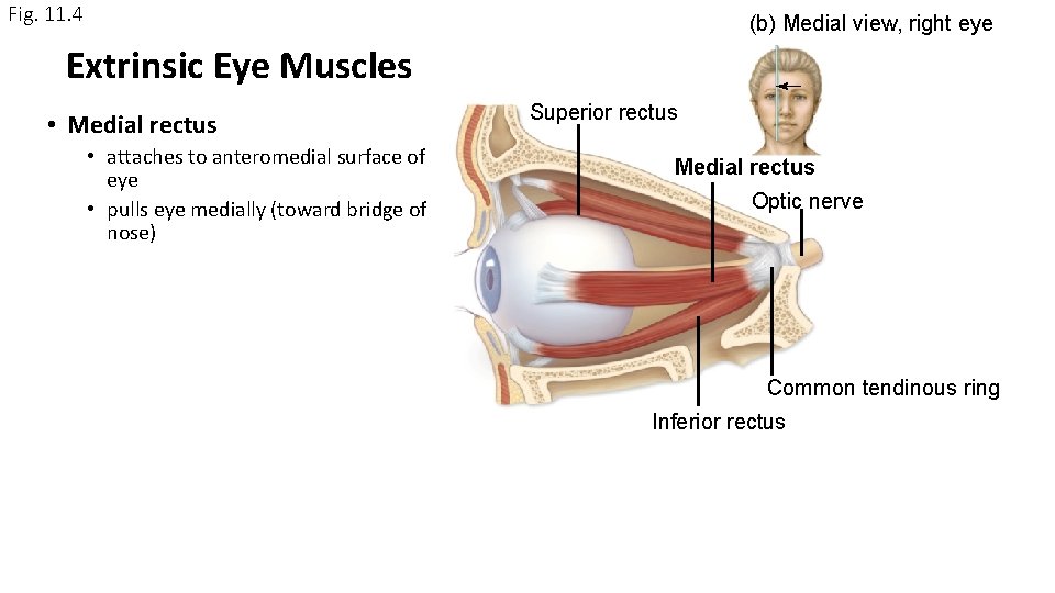 Fig. 11. 4 (b) Medial view, right eye Extrinsic Eye Muscles • Medial rectus Fig. 11. 4 (b) Medial view, right eye Extrinsic Eye Muscles • Medial rectus
