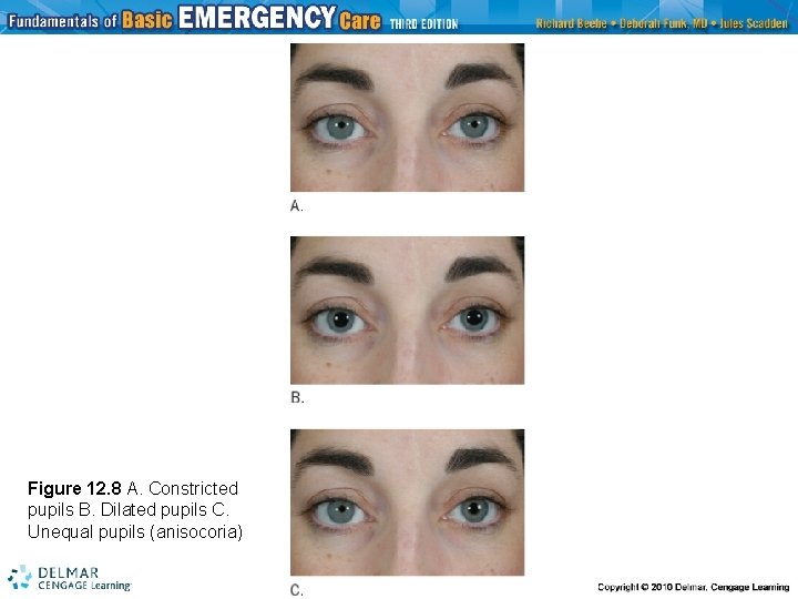 Figure 12. 8 A. Constricted pupils B. Dilated pupils C. Unequal pupils (anisocoria) 