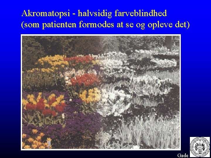 Akromatopsi - halvsidig farveblindhed (som patienten formodes at se og opleve det) Gade 