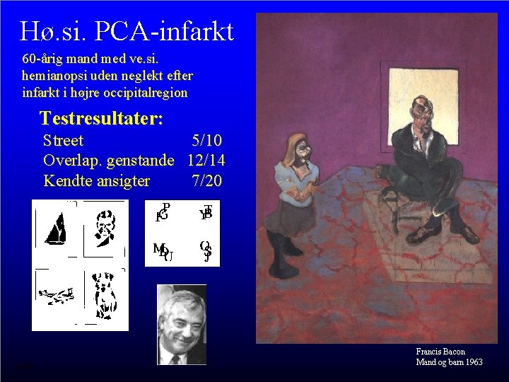 Hø. si. PCA-infarkt 60 -årig mand med ve. si. hemianopsi uden neglekt efter infarkt