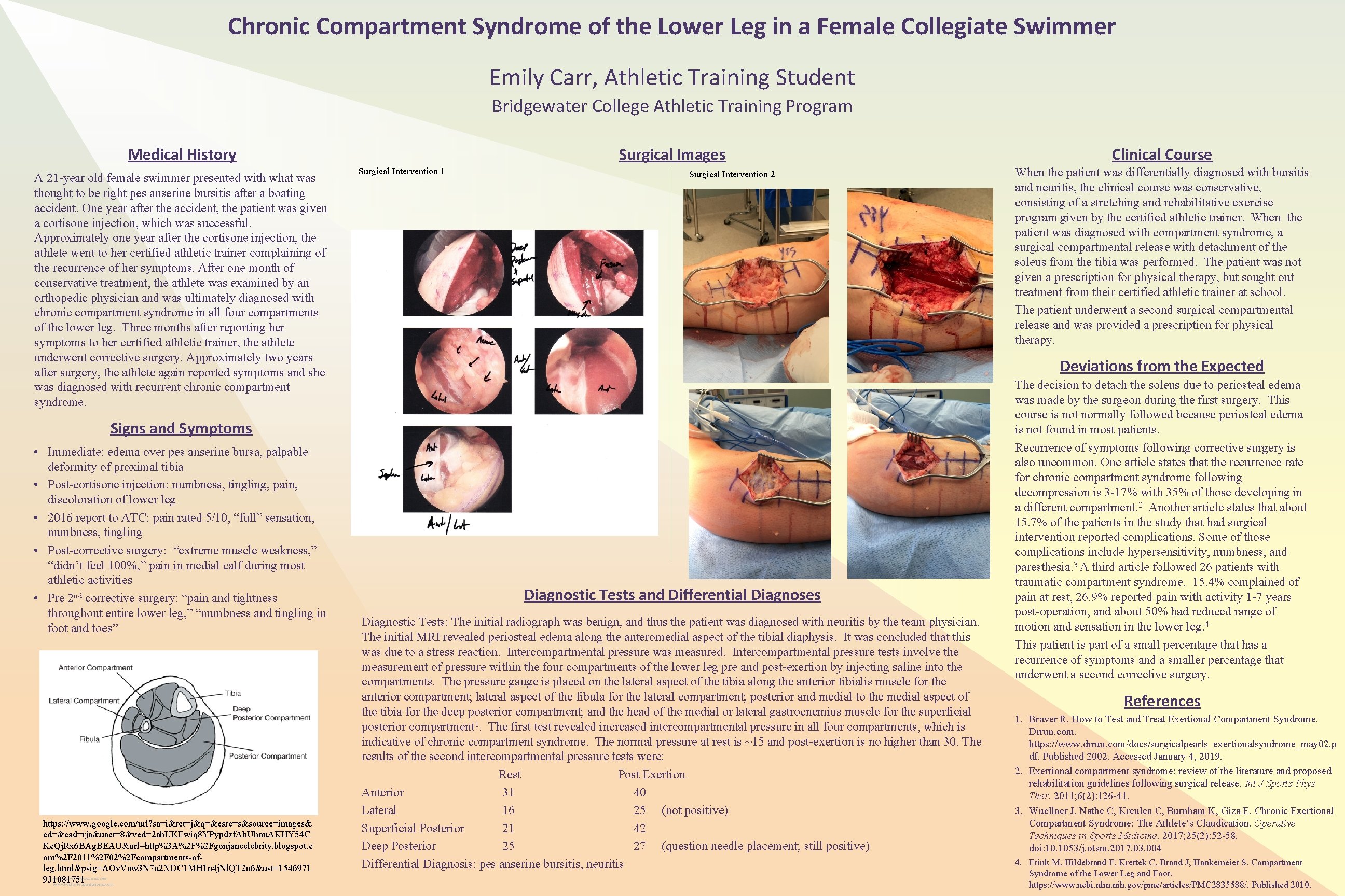 Chronic Compartment Syndrome of the Lower Leg in a Female Collegiate Swimmer Emily Carr, Chronic Compartment Syndrome of the Lower Leg in a Female Collegiate Swimmer Emily Carr,