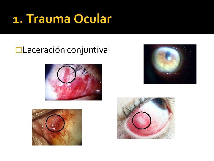 1. Trauma Ocular �Laceración conjuntival 