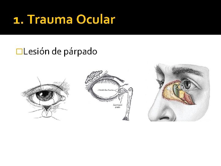 1. Trauma Ocular �Lesión de párpado 