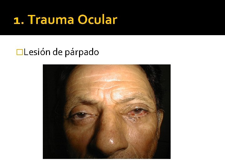 1. Trauma Ocular �Lesión de párpado 