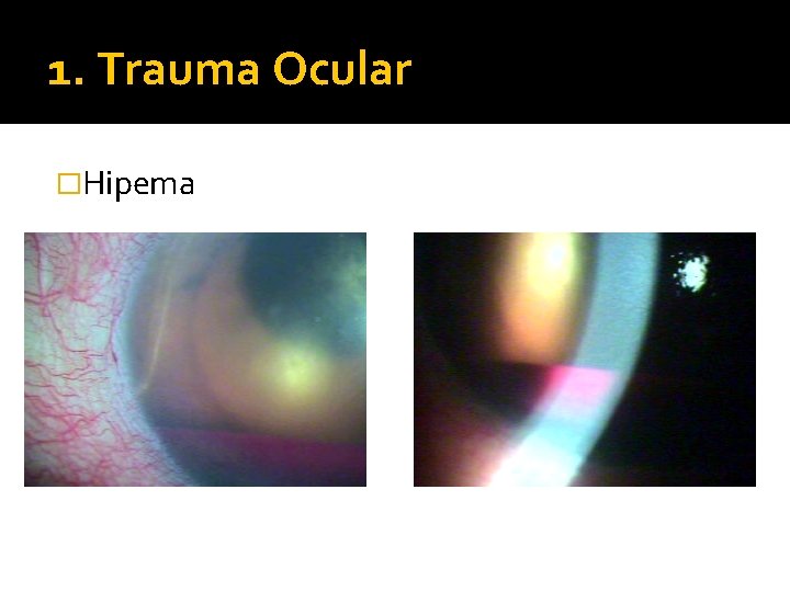 1. Trauma Ocular �Hipema 