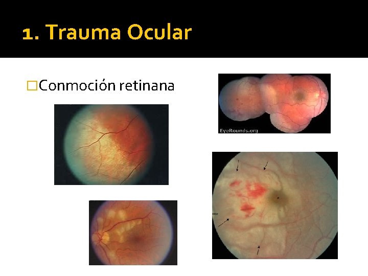 1. Trauma Ocular �Conmoción retinana 