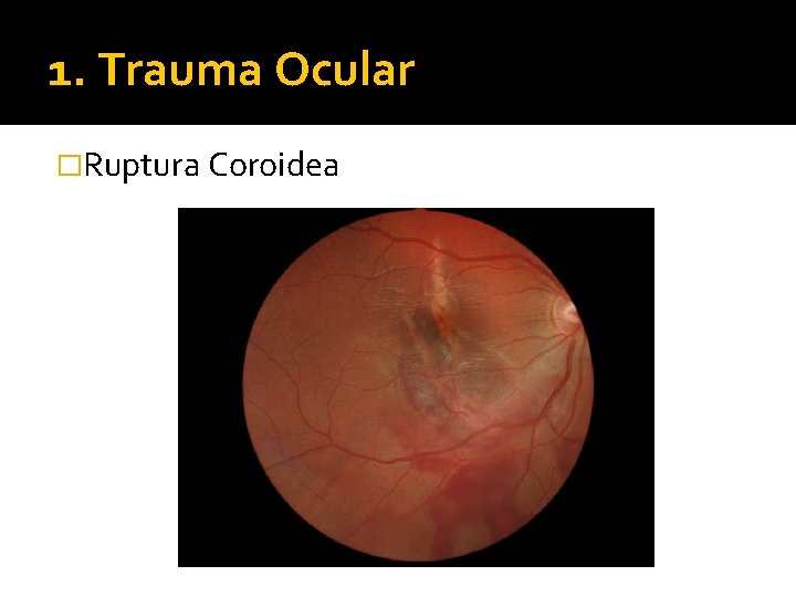 1. Trauma Ocular �Ruptura Coroidea 