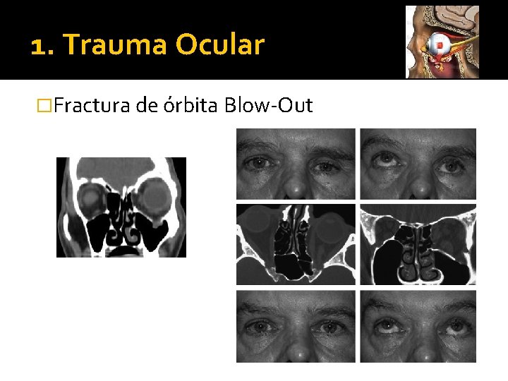 1. Trauma Ocular �Fractura de órbita Blow-Out 