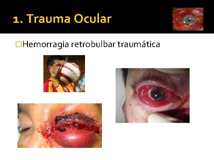 1. Trauma Ocular �Hemorragia retrobulbar traumática 