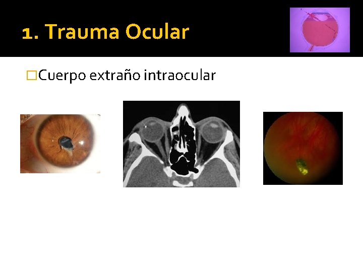 1. Trauma Ocular �Cuerpo extraño intraocular 