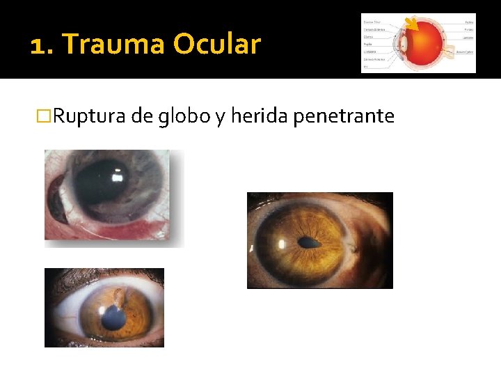 1. Trauma Ocular �Ruptura de globo y herida penetrante 