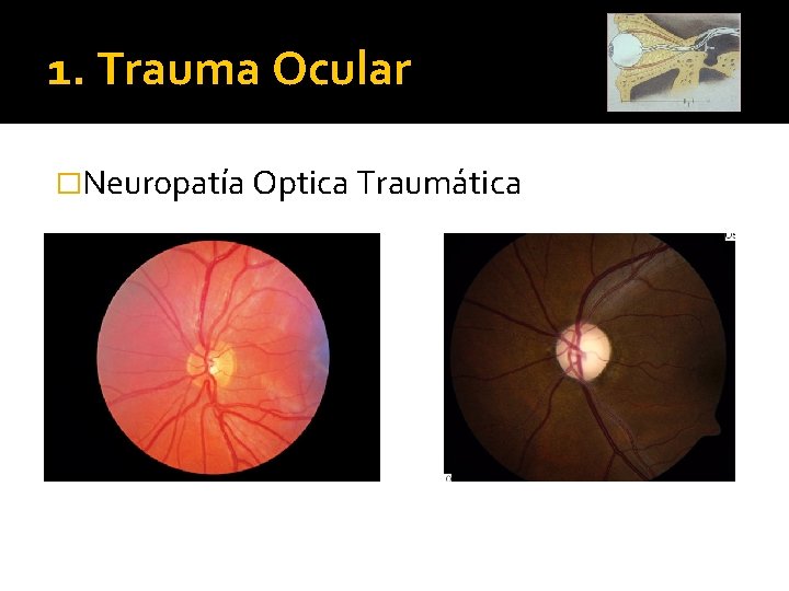 1. Trauma Ocular �Neuropatía Optica Traumática 