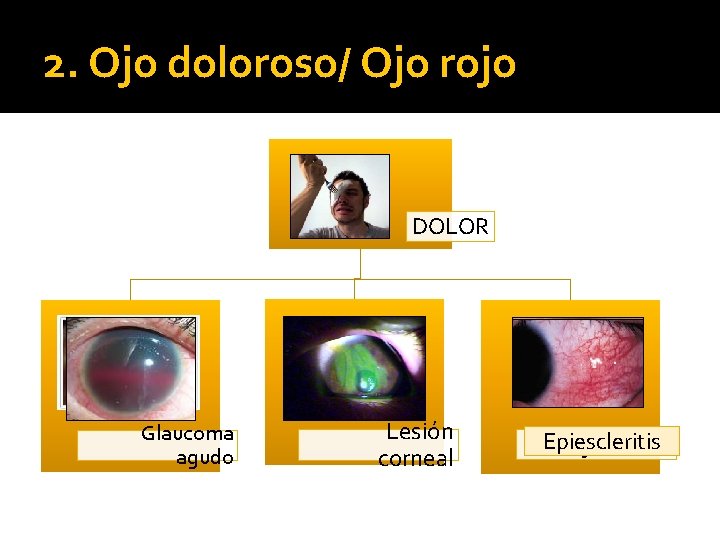 2. Ojo doloroso/ Ojo rojo DOLOR Glaucoma agudo Lesión corneal Epiescleritis Conjuntivitis 