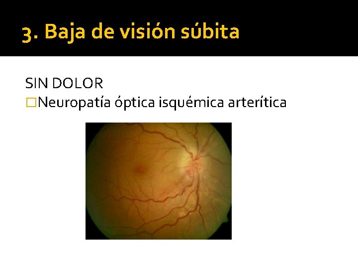 3. Baja de visión súbita SIN DOLOR �Neuropatía óptica isquémica arterítica 