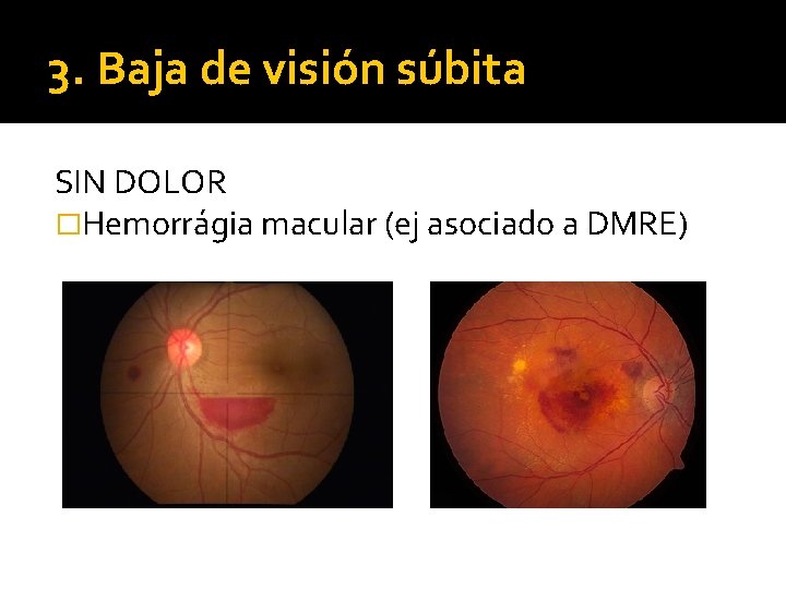 3. Baja de visión súbita SIN DOLOR �Hemorrágia macular (ej asociado a DMRE) 