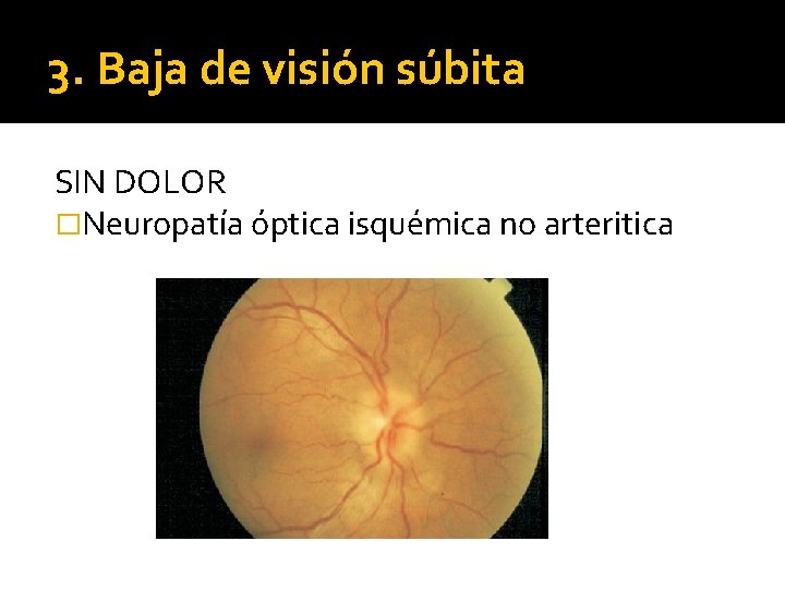 3. Baja de visión súbita SIN DOLOR �Neuropatía óptica isquémica no arteritica 