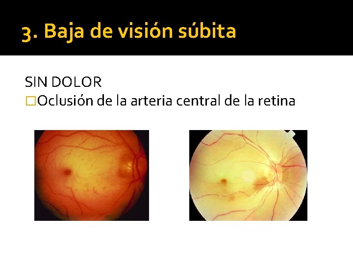3. Baja de visión súbita SIN DOLOR �Oclusión de la arteria central de la