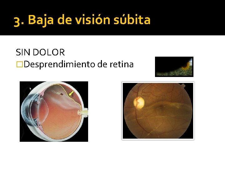 3. Baja de visión súbita SIN DOLOR �Desprendimiento de retina 