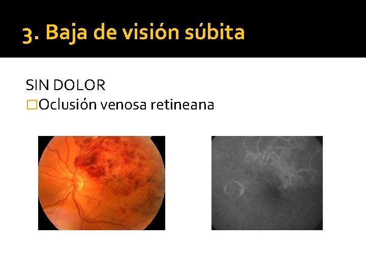 3. Baja de visión súbita SIN DOLOR �Oclusión venosa retineana 