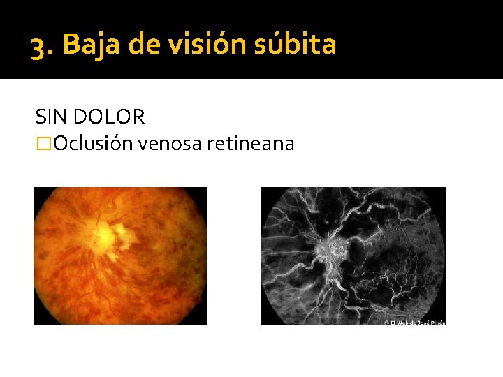 3. Baja de visión súbita SIN DOLOR �Oclusión venosa retineana 