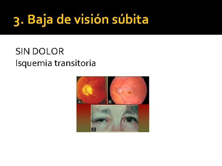 3. Baja de visión súbita SIN DOLOR Isquemia transitoria 