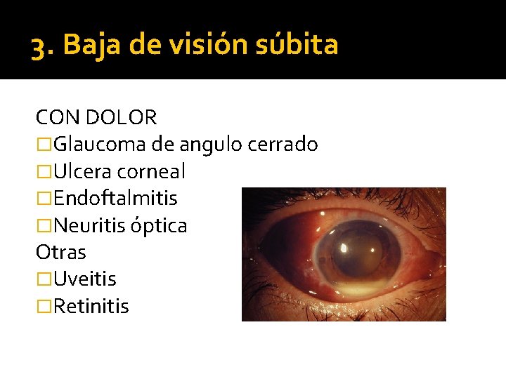 3. Baja de visión súbita CON DOLOR �Glaucoma de angulo cerrado �Ulcera corneal �Endoftalmitis