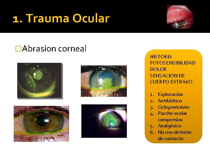 1. Trauma Ocular �Abrasion corneal HISTORIA FOTOSENSIBILIDAD DOLOR SENSACION DE CUERPO EXTRAñO 1. 2.