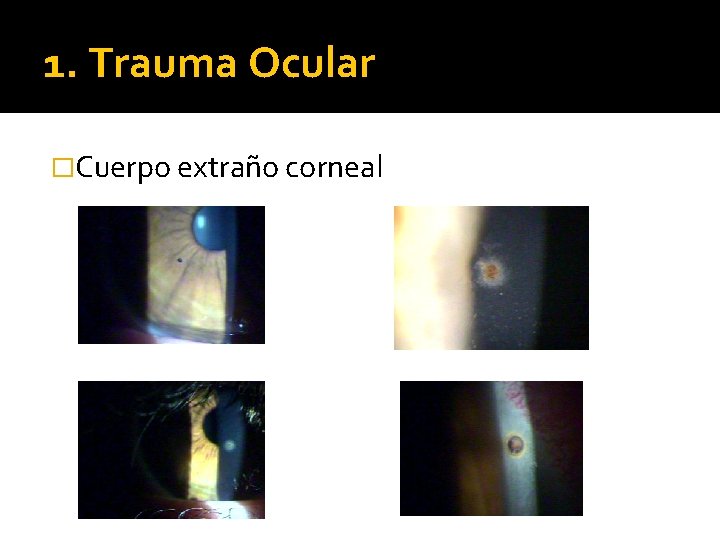 1. Trauma Ocular �Cuerpo extraño corneal 