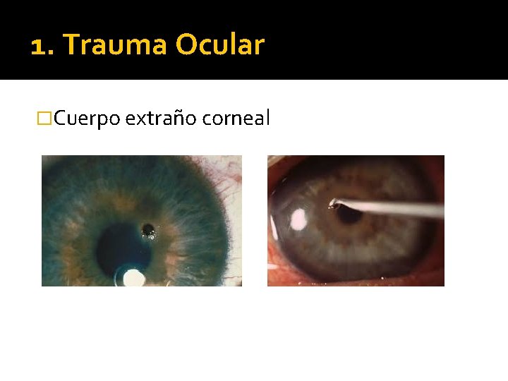 1. Trauma Ocular �Cuerpo extraño corneal 