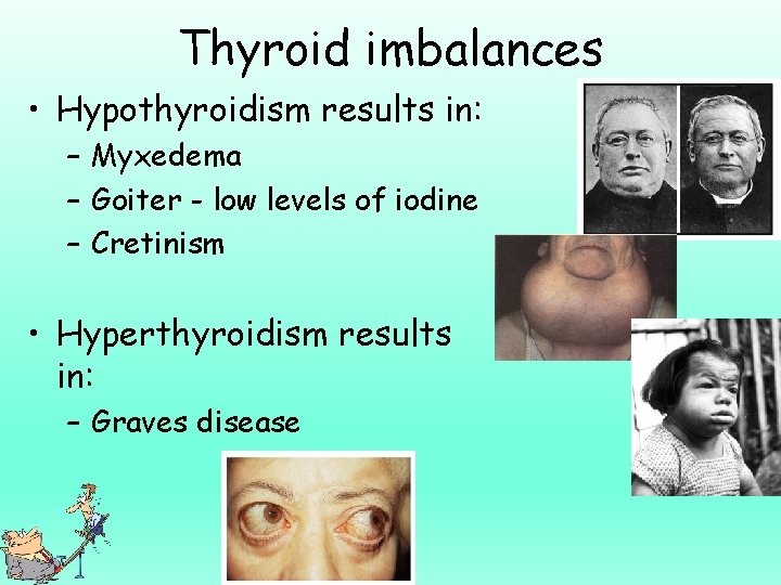 Thyroid imbalances • Hypothyroidism results in: – Myxedema – Goiter - low levels of