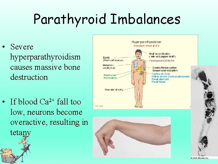 Parathyroid Imbalances • Severe hyperparathyroidism causes massive bone destruction • If blood Ca 2+