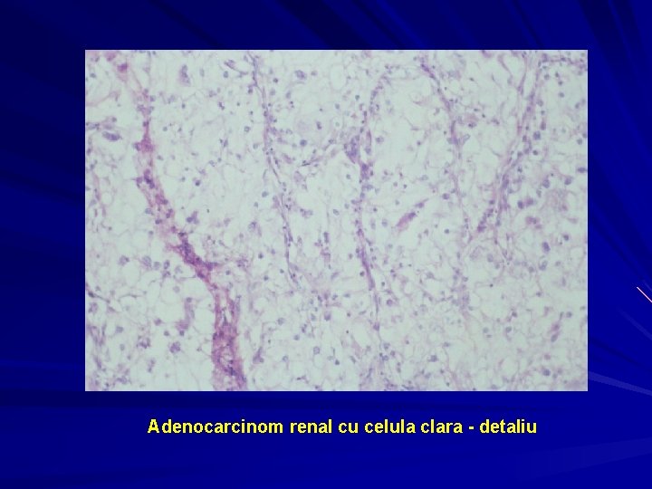 Adenocarcinom renal cu celula clara - detaliu 