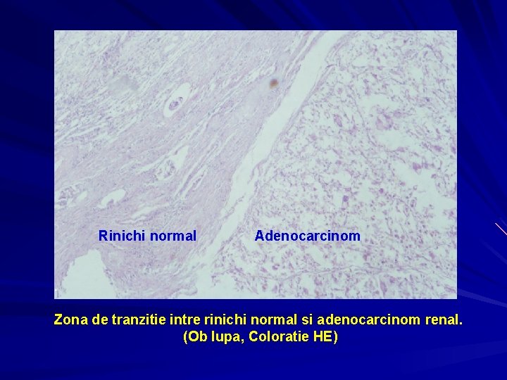 Rinichi normal Adenocarcinom Zona de tranzitie intre rinichi normal si adenocarcinom renal. (Ob lupa,