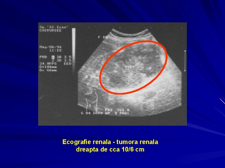 Ecografie renala - tumora renala dreapta de cca 10/6 cm 