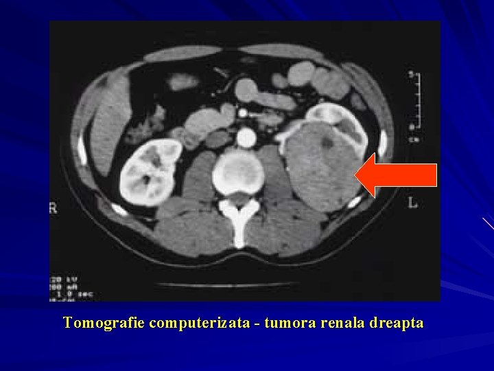 Tomografie computerizata - tumora renala dreapta 