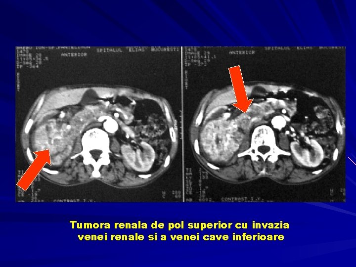 Tumora renala de pol superior cu invazia venei renale si a venei cave inferioare