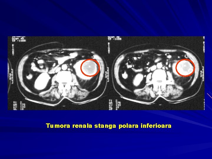 Tumora renala stanga polara inferioara 