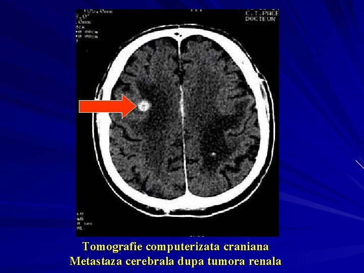 Tomografie computerizata craniana Metastaza cerebrala dupa tumora renala 