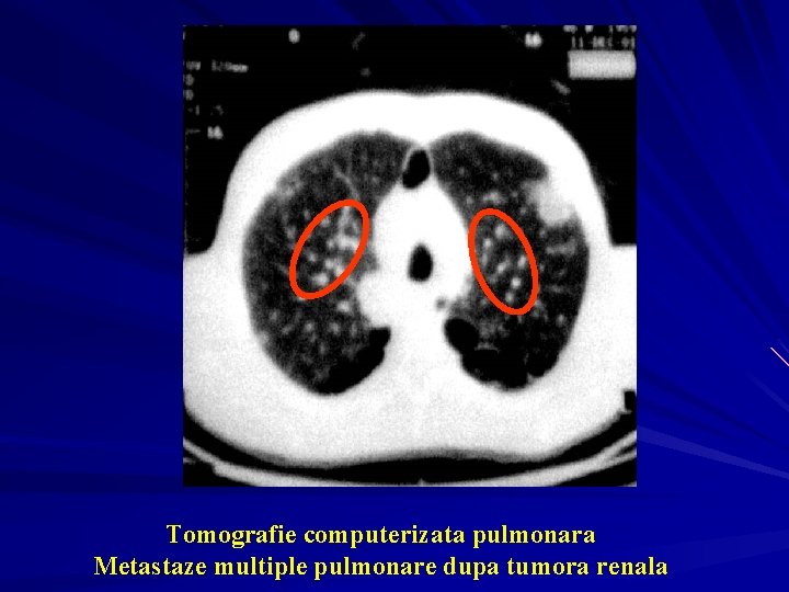 Tomografie computerizata pulmonara Metastaze multiple pulmonare dupa tumora renala 