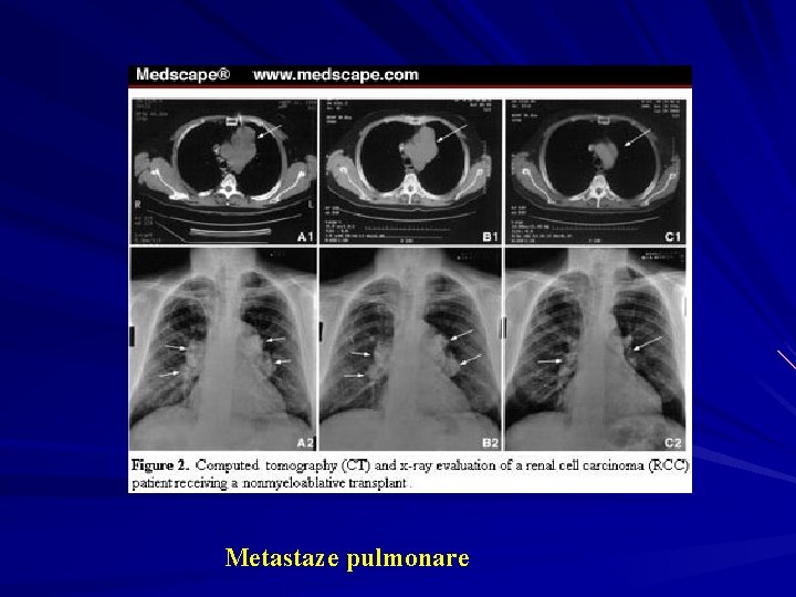 Metastaze pulmonare 