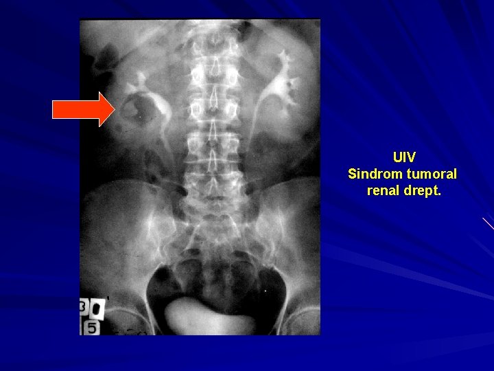 UIV Sindrom tumoral renal drept. 