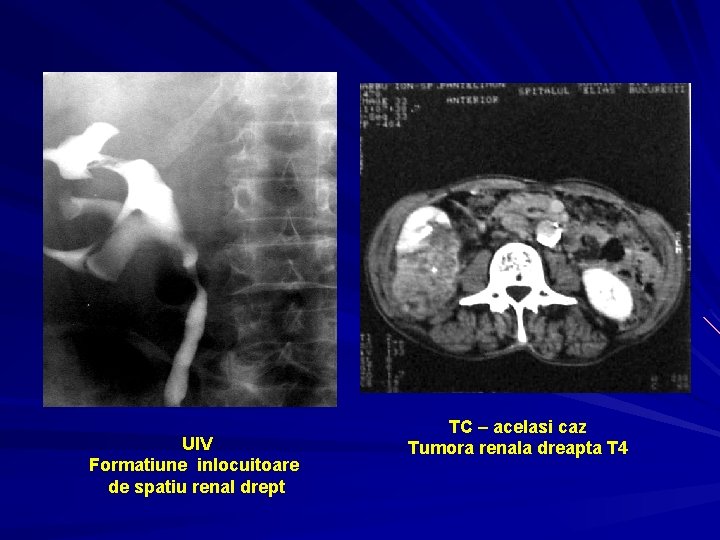 UIV Formatiune inlocuitoare de spatiu renal drept TC – acelasi caz Tumora renala dreapta