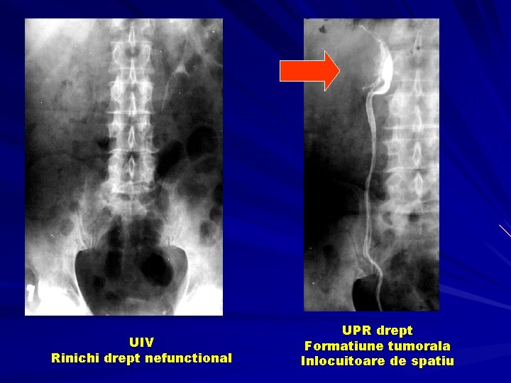 UIV Rinichi drept nefunctional UPR drept Formatiune tumorala Inlocuitoare de spatiu 