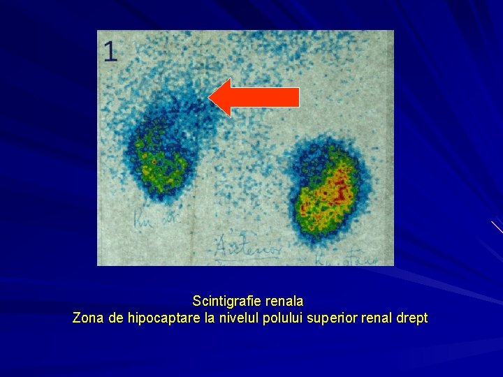 Scintigrafie renala Zona de hipocaptare la nivelul polului superior renal drept 